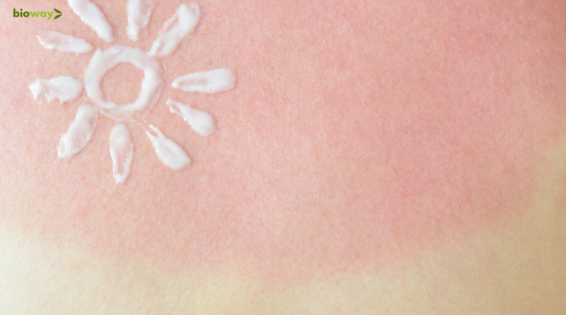 remedii arsuri solatre